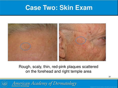 Ppt Actinic Keratosis And Squamous Cell Carcinoma Powerpoint