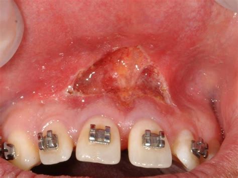 Labial Frenectomy With Ndyag Laser And Conventional Surgery
