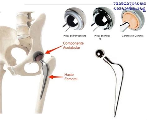 Componentes Da Prótese Total De Quadril Traumatologia E Ortopedia
