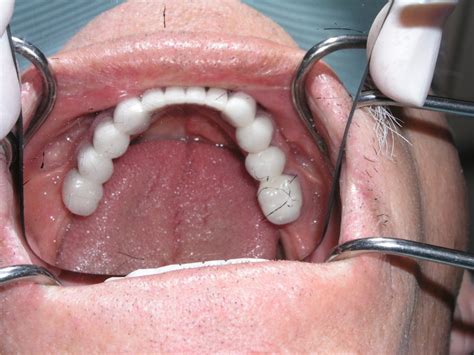 Cross Arch Stabilization For Adult Cleft Palate Patient