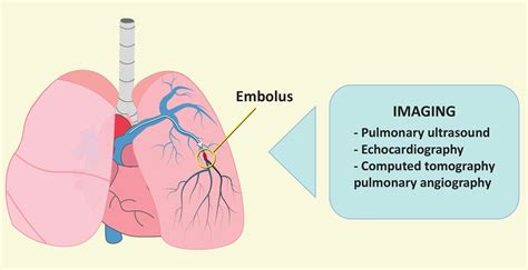 jcm free full text pulmonary embolism presenting with pulmonary infarction update and
