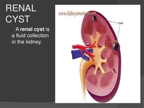 Renal Cyst Classification