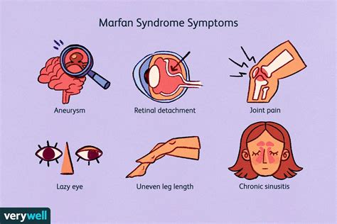 Marfan Syndrome Symptoms Treatment Life Expectancy