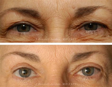 Eyelid Surgery In Jackson Ms Blepharoplasty Faces