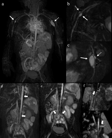 Bilateral Axillary Artery Aneurysms In A 1 Year Old Male With Kawasaki