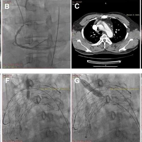 The Perioperative Images Of The Thoracic Endovascular Aortic Repair