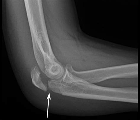 Elbow Olecranon Fractures Orthoinfo Aaos