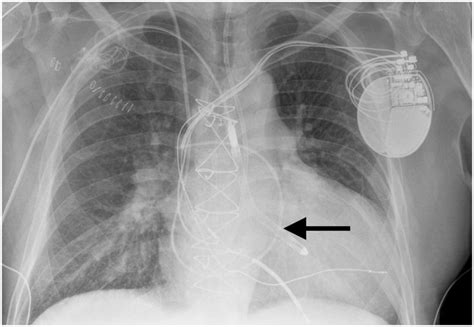 Chest Radiograph Depicting Impella 55 Placement In The Left Ventricle