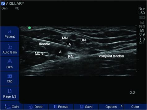 Ultrasound Guided Axillary Brachial Plexus Block Anesthesia Key