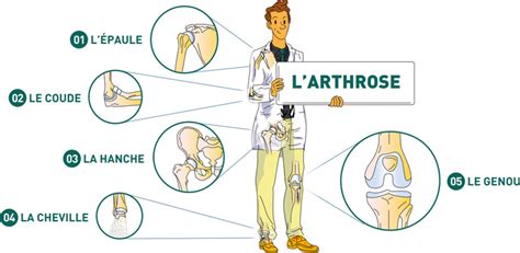 Traitement De Larthrose à Paris Dr Mylle Chirurgien Orthopédiste