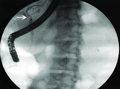 Endoscopic Retrograde Cholangiopancreatography Ercp Indicates That