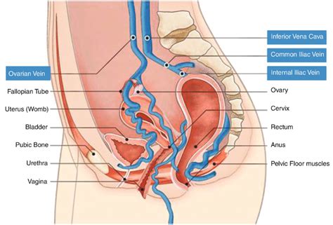 Vaginal And Vulval Varicose Veins Dr Marek Sepiolo