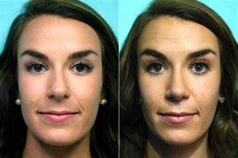 Rhinoplasty Photos Chevy Chase Md Patient 17902