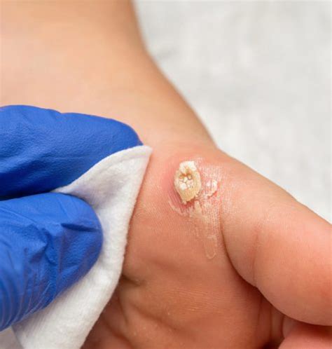 plantar warts southernmost foot and ankle specialists