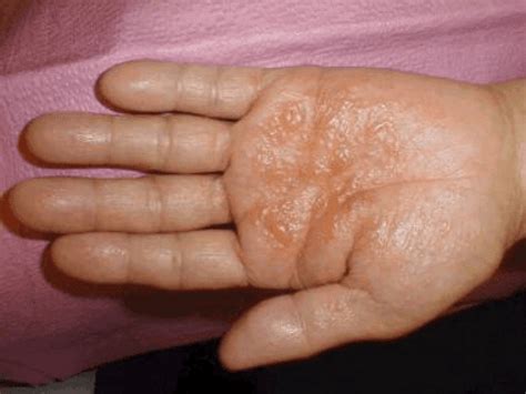 Brief Guidance On Different Types Of Eczematous Dermatitis Basic Baby