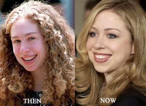 siva sonipatty blog: Chelsea Clinton Nose Job Before After