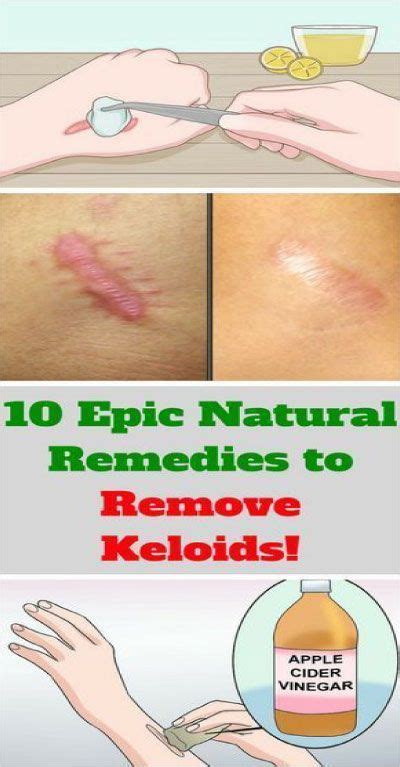 How To Treat Keloids Home Remedy Ho Modulartz