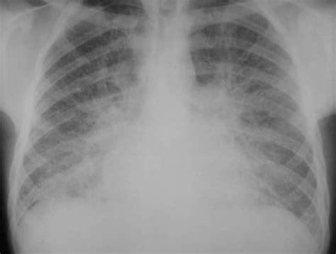 Please see disclaimer on my website www.academyofprofessionals.com. Pulmonary edema chest x ray - wikidoc