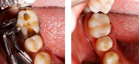 Amalgame Et Composite — Vo Dentistes