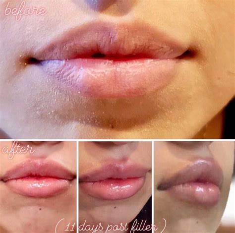Juvéderm Volbella® Juvederm How To Line Lips Lip Fillers