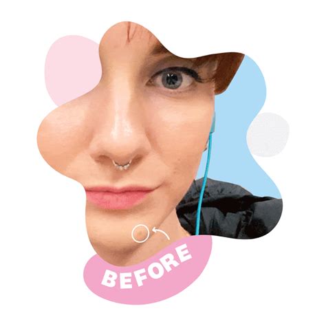 These Before And After Zitsticka Photos Will Make You Believe In Pimple Patches