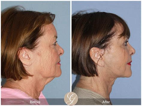 Neck Lift 405 Before After Photos Orange County