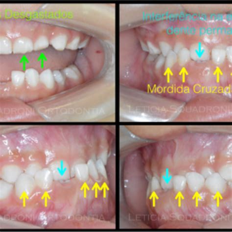 Dente Encavalado Antes E Depois Antes E Depois Do Aparelho Dente Encavalado