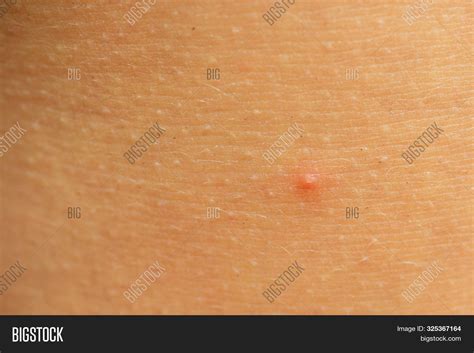 Post Acne Scars Red Image And Photo Free Trial Bigstock