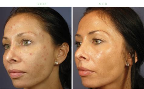 Chemical Peel Long Beach Cosmetic Procedures By Leading Physicians
