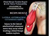 Distal Bicep Tendon Tear Recovery Time Images