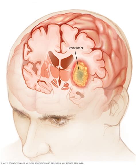 Overview Brain Tumor Mayo Clinic