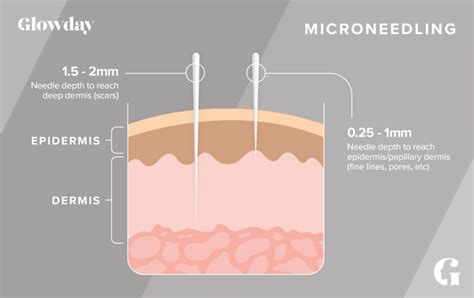 Microneedling Benefits What Microneedling Does For Skin Glowday