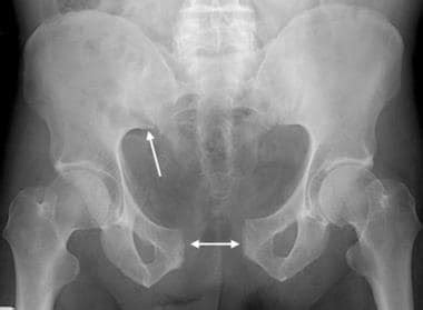 Pelvic Fracture Imaging Practice Essentials Computed Tomography