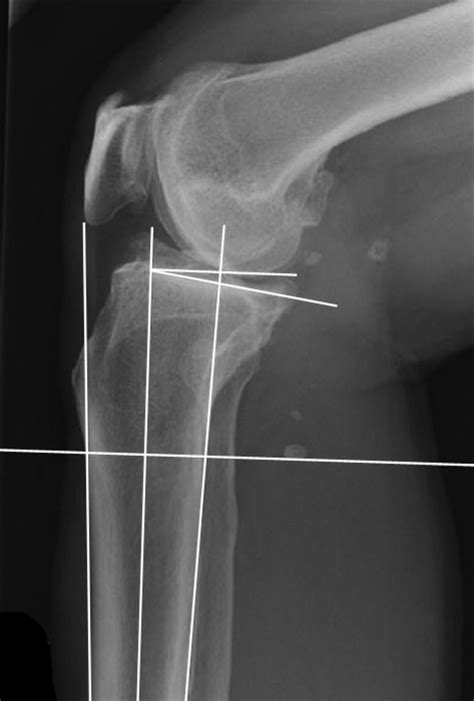 Restoring The Anatomical Tibial Slope And Limb Axis May Maximise Post