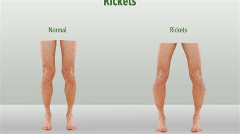 Rickets What It Is And How To Treat Them Rahul Khanna Medium