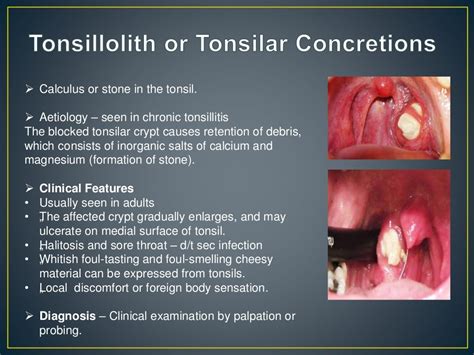 Palatine Tonsil Its Anatomy Diseases And Their Management