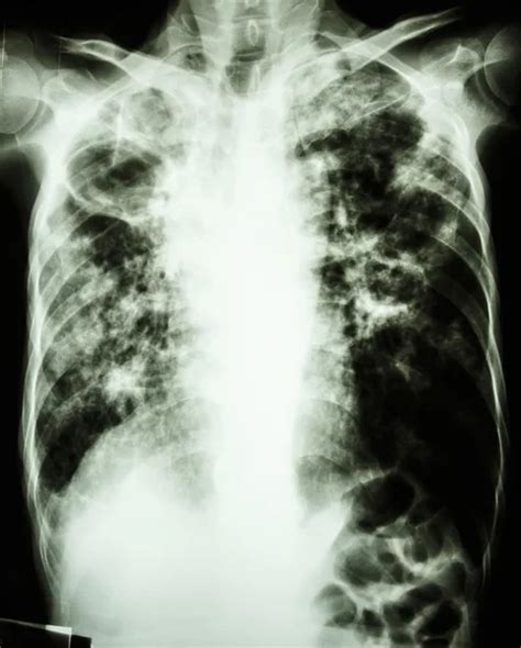 Pulmonary Tuberculosis Film Chest X Ray Of Old Patient Show