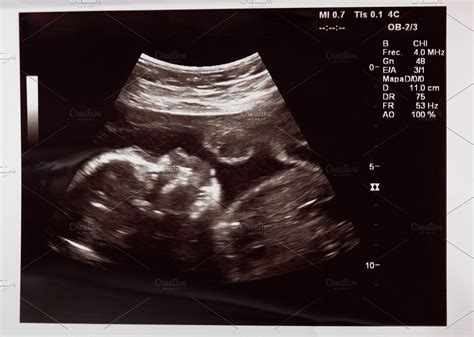 Baby Head On Ultrasound Scan High Quality Health Stock Photos