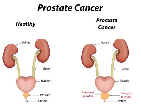 14 Surprising Home Remedies For Prostate Cancer Organic Facts