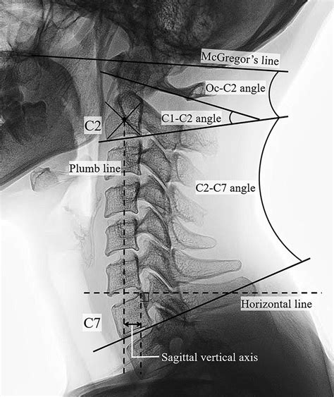Sagittal Alignment Correlates With The C1 C2 Fixation Angle And