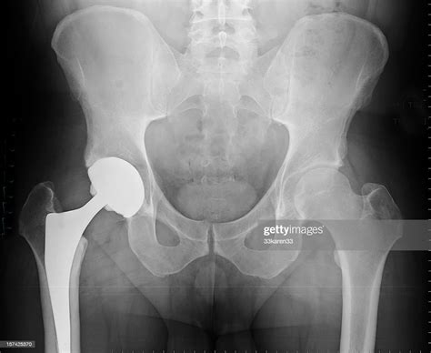 Xray Of Total Hip Arthroplasty Stock Photo Getty Images