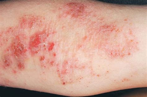 What Its Like To Live With Severe Eczema The Healthy