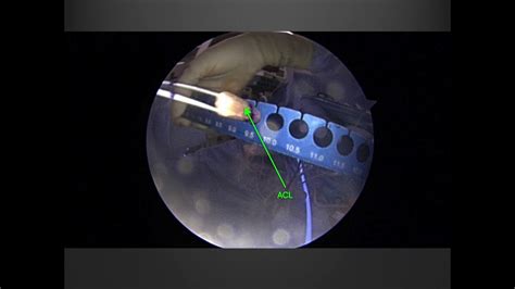 Acl Reconstruction How To Interpret Key Surgical Images Youtube