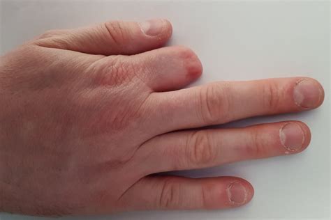 Primeros Auxilios En Caso De Amputación Accidental De Un Dedo — Mejor