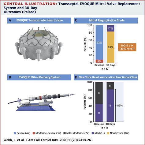 Transcatheter Mitral Valve Replacement With The Transseptal Evoque