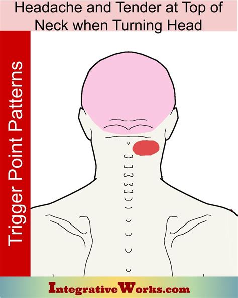 Headache With Tender Top Of Neck While Turning Cervicogenic Headache