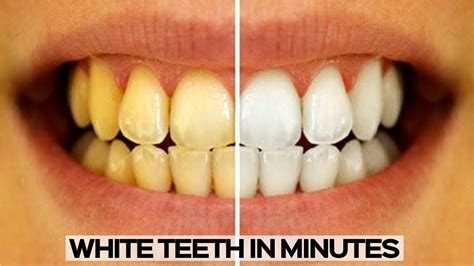 How To Whiten Your Teeth Easy And Quick Teeth Whitening 2023 Youtube