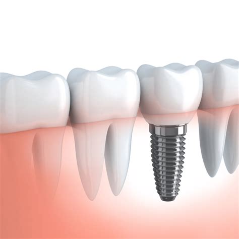 Dental Implant Facts Charleston Oral And Facial Surgery