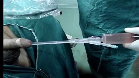 Transurethral Resection Of The Prostate Without Postoperative Irrigation YouTube
