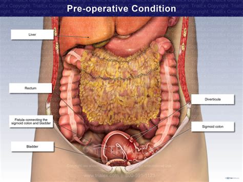 pre operative condition trialexhibits inc